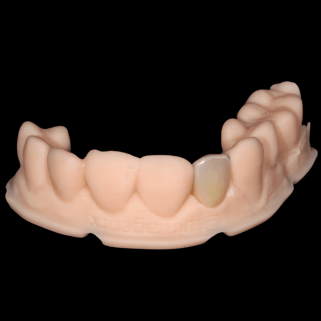 Carillas en feldespato, disilicato, zirconio, resina 3D impresa