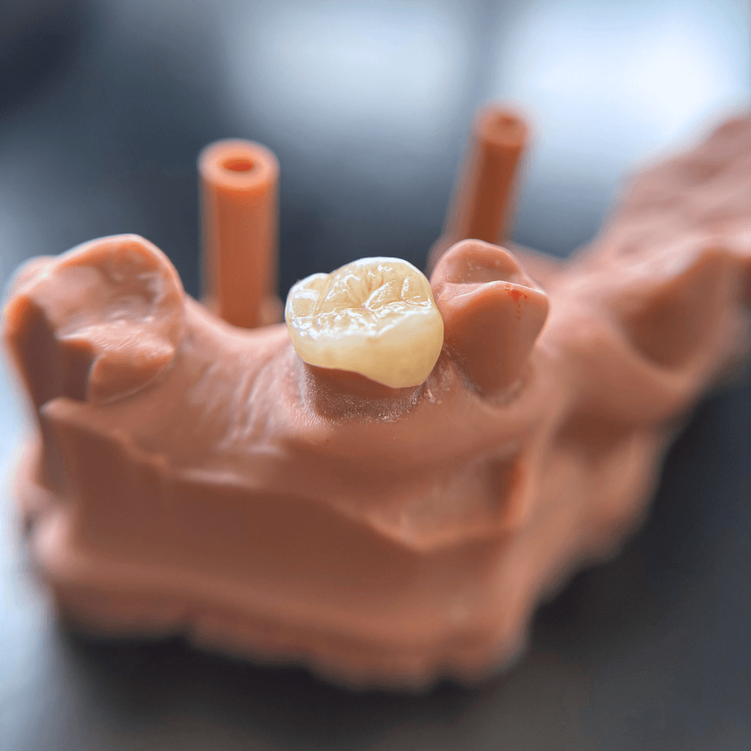 Coronas en feldespato, disilicato, zirconio, resina 3D impresa