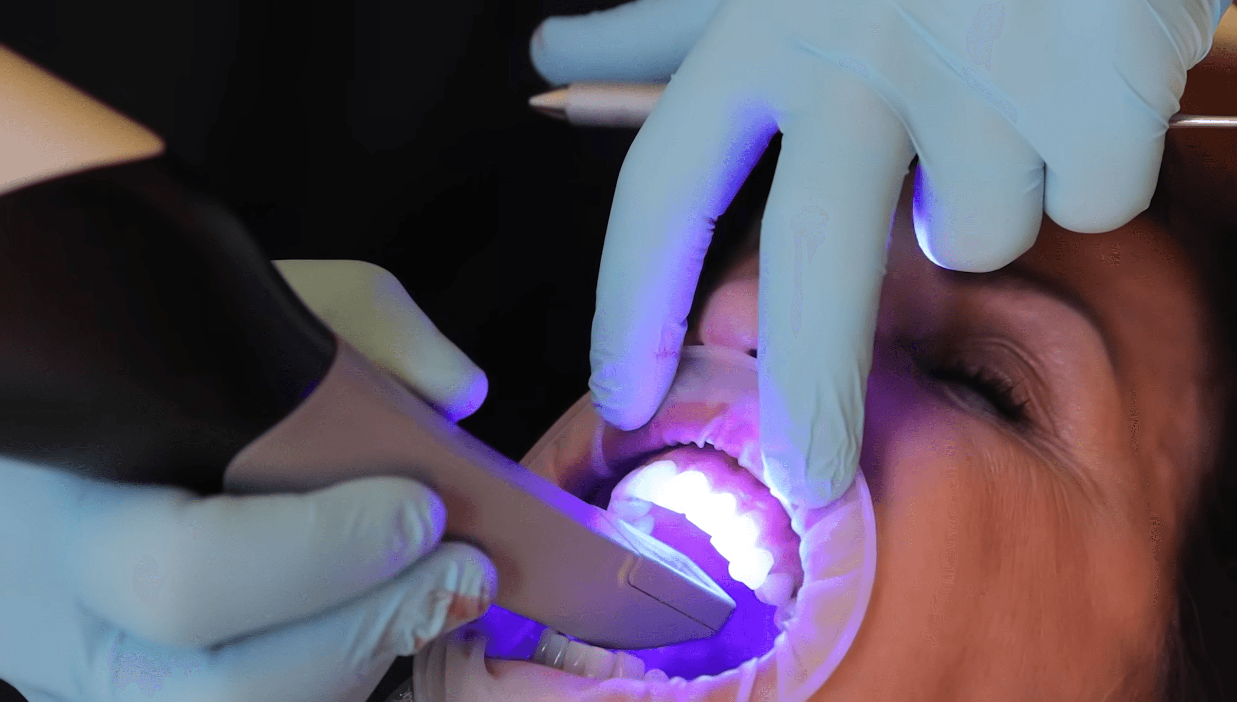 Escaneo intraoral
