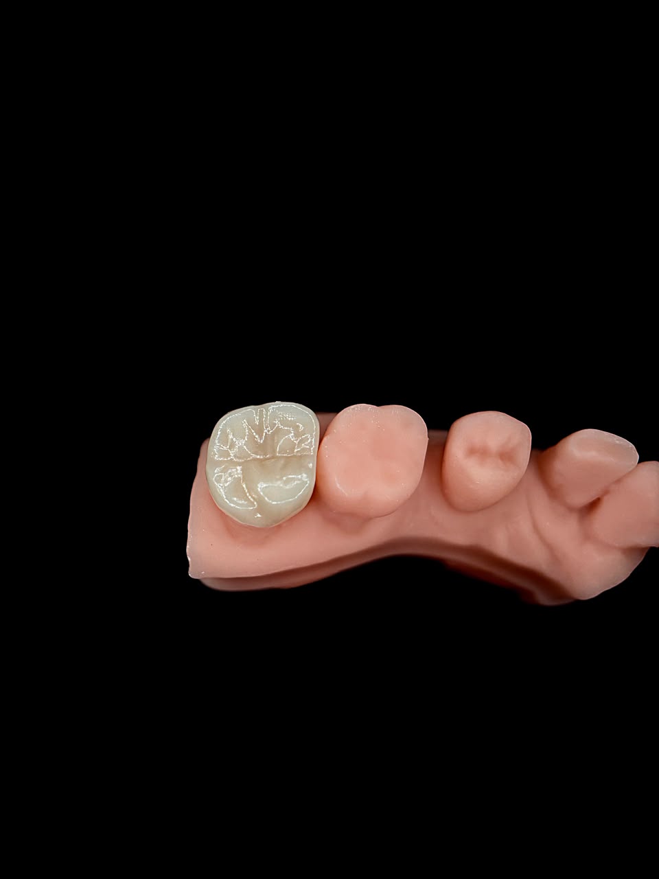 Corona posterior verificada sobre modelo impreso en 3D