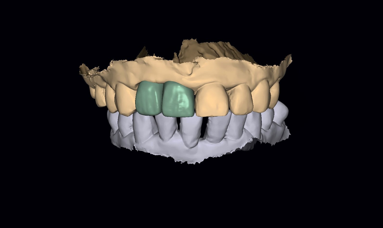 Diseño digital de coronas anteriores en CAD